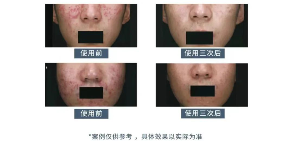 焕肤“肌”密 刷酸之旅|南丹县中医医院皮肤科开展刷酸治疗