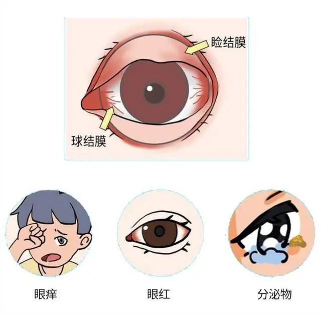 【健康科普】眼部又红又痒，可能是过敏性结膜炎